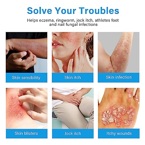 Jock Itch Cream, Max Relief for Tinea Cruris, Athlete's Foot and