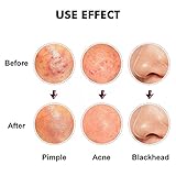 Blackhead & Splinter Remover Tools - Stainless Steel Professional Easily Cure Pimples Whiteheads Comedones Acne Zit Ingrown Hairs and Facial Impurities Bend Head Tweezer Surgical Kit by FIXBODY