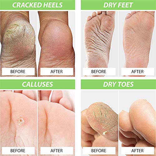 Get your feet looking and feeling healthy with the Complete 3-in-1 Foot Fungus Treatment Set from Foot Cure. This amazing foot care set includes a nail repair pen that effectively eliminates toenail fungus and discoloration, a tea tree oil foot soak that works wonders against odor, bacteria and swollen feet, and an incredible foot balm for cracked heels and dry, aching feet. This set uses a proprietary blend of natural ingredients such as Epsom salt, sea salt, eucalyptus, peppermint, MSM, and essential oils of tea tree to provide advanced antifungal care that also soothes and rejuvenates tired, swollen feet.