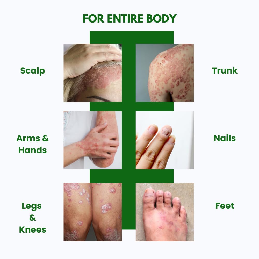 PSODEX Psoriasis Cream – 3.4fl oz Topical Psoriasis Treatment with Coal Tar, Salicylic Acid, Tea Tree Oil, Aloe Vera – All-Natural Ingredients – Soothing and Moisturizing Coal Tar Psoriasis Cream