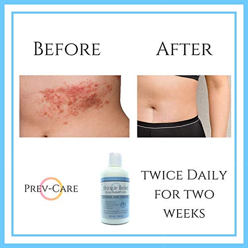 Shingles Lotion Cream for Pain Relief and skin affected by Shingles and
