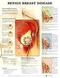 Benign Breast Conditions Anatomical Chart, Anatomical Chart Company Staff, 1587796740