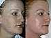TCA 100 Chemical Skin Peel Kit - Tattoo remover, Age Spots, Skin Tags, Warts, Moles! Various Strengths (1 DRAM / 4ML) by RePare, LLC