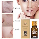 Birdfly 2 Pcs Brightening Dark Spots Removal Age Hyper Pigmentation Extract Acne Scars Marks Treatment Facial Freckle Essential Oil