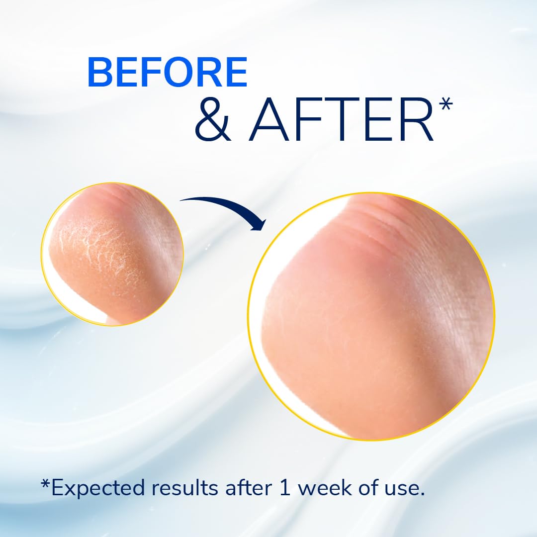 Dr. Scholl's Severe Cracked Heel Repair Restoring Balm 2.5oz, with 25% Urea for Dry, Cracked Feet, Heals and Moisturizes for Healthy Feet