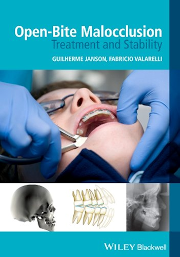 Download Open-Bite Malocclusion: Treatment and Stability (English Edition) PDF