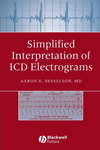 Simplified Interpretation of ICD Electrograms