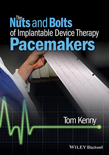 Amazon Com The Nuts And Bolts Of Implantable Device Therapy Pacemakers The Nuts And Bolts Series Ebook Kenny Tom Kindle Store