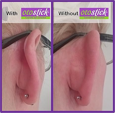 Corrección instantánea para orejas prominentes de Otostick, 3 paquetes: Amazon.es: Salud y cuidado personal