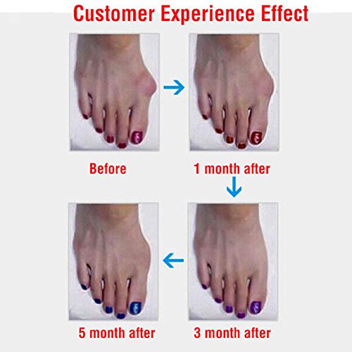 1 Pair=2 Pcs Gel Silicone Bunion Corrector Big Toe Separators Straightener Spreader Foot Care Tool Hallux Valgus Pro massager