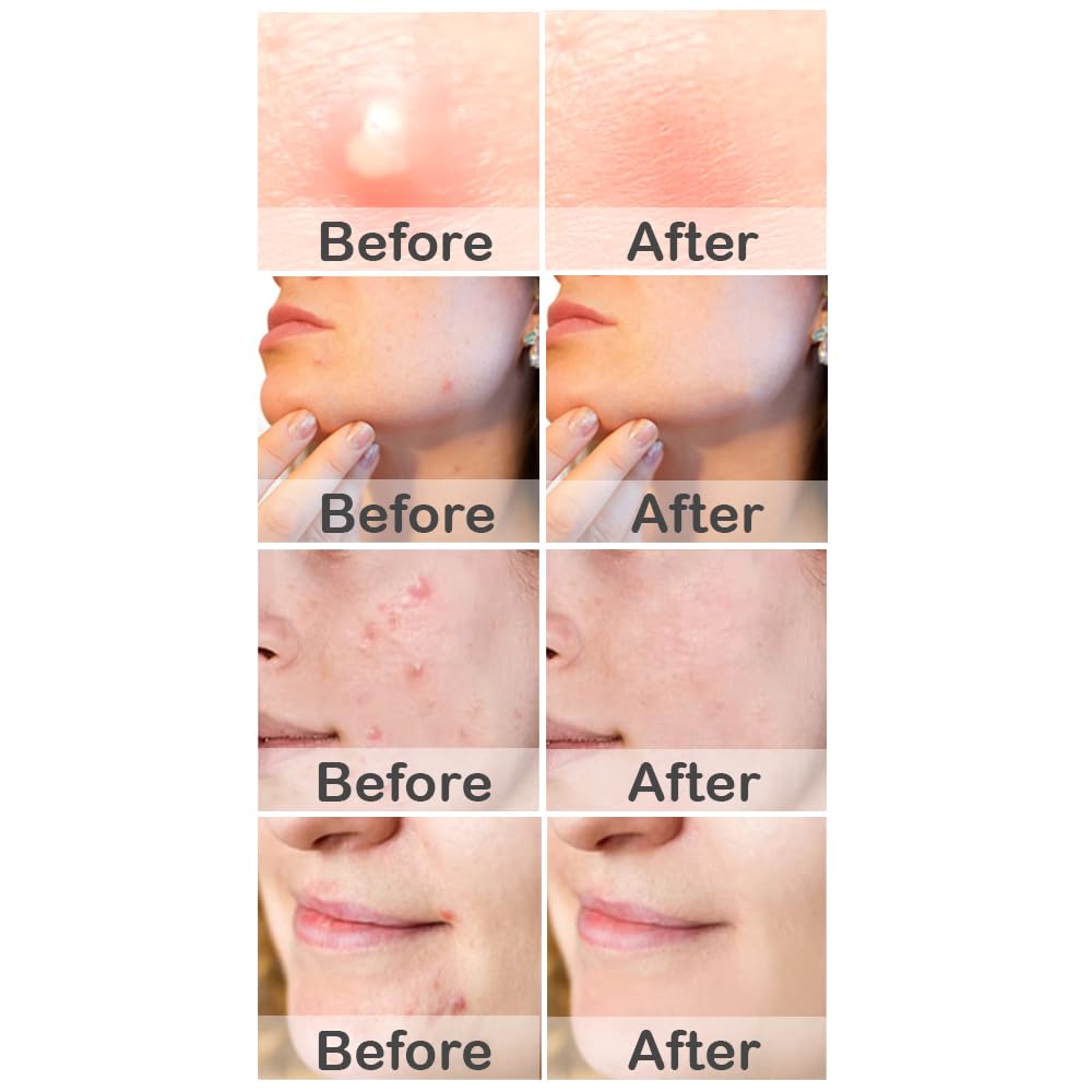 MioMera Pimple Patches, Invisible Pimple Patches for Face, Hydrocolloid Acne Patches, Zit Patches for All Skin Types, Easy Peel Acne Patch, Pimple Patch for Day and Night Use