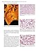 Diagnostic Histopathology of Tumors: 2 Volume Set: Expert Consult - Online and Print (DIAGNOSTIC HISTOPATHOLOGY OF TUMORS (FLETCHER))