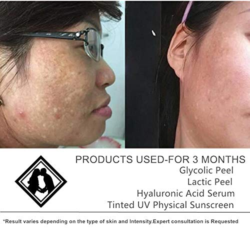 Amazon Com Asdm Beverly Hills 10 Glycolic Acid Medical Strength 1oz 30ml Professional Chemical Peels Home Spa Facial Peels For Normal Oil Skin Acne Scars Beauty