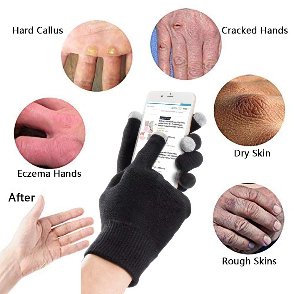 cracked skin on hands eczema