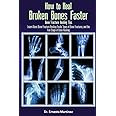 How to Heal Broken Bones Faster. Bone Fracture Healing Tips: Learn About Bone Fracture Healing Foods, Types of Bone Fractures, and the Five Stages of Bone Healing (Health and Wellness)
