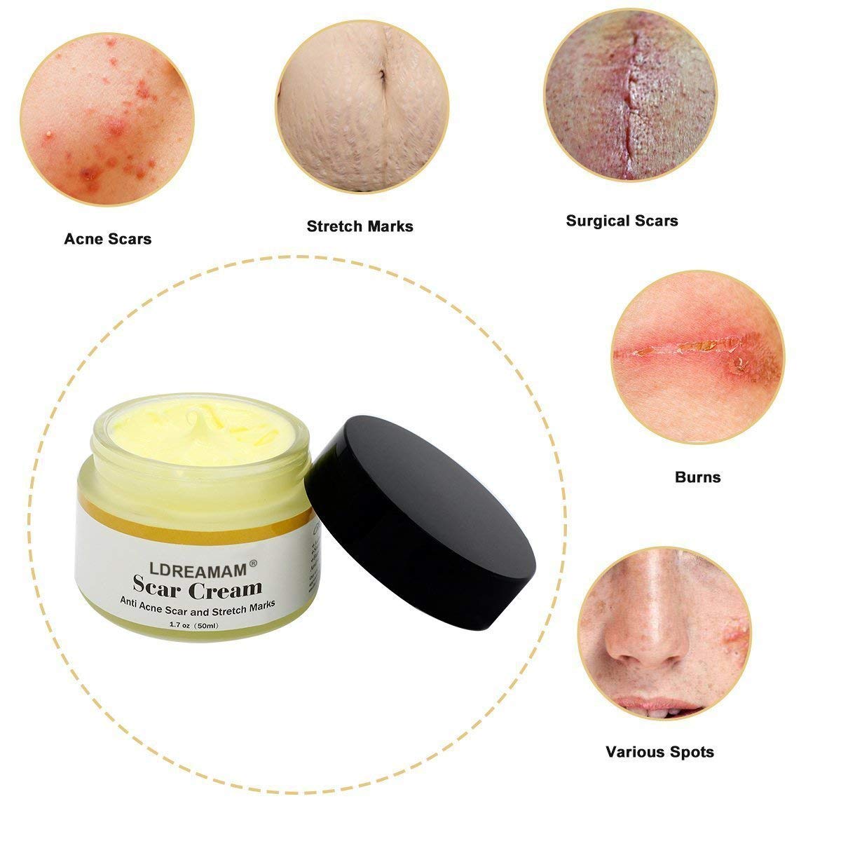 Acne Scar Removal Cream,Scar Cream,Scar Gel,Skin Repair Cream,Treatment