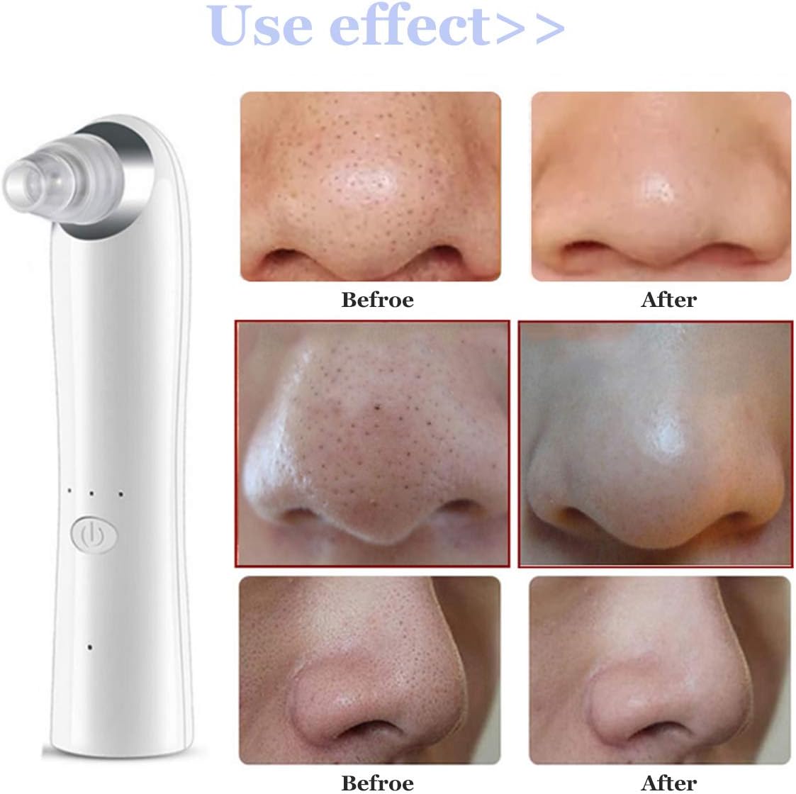 Eliminador de puntos negros, aspirador de puntos negros, limpiador ...