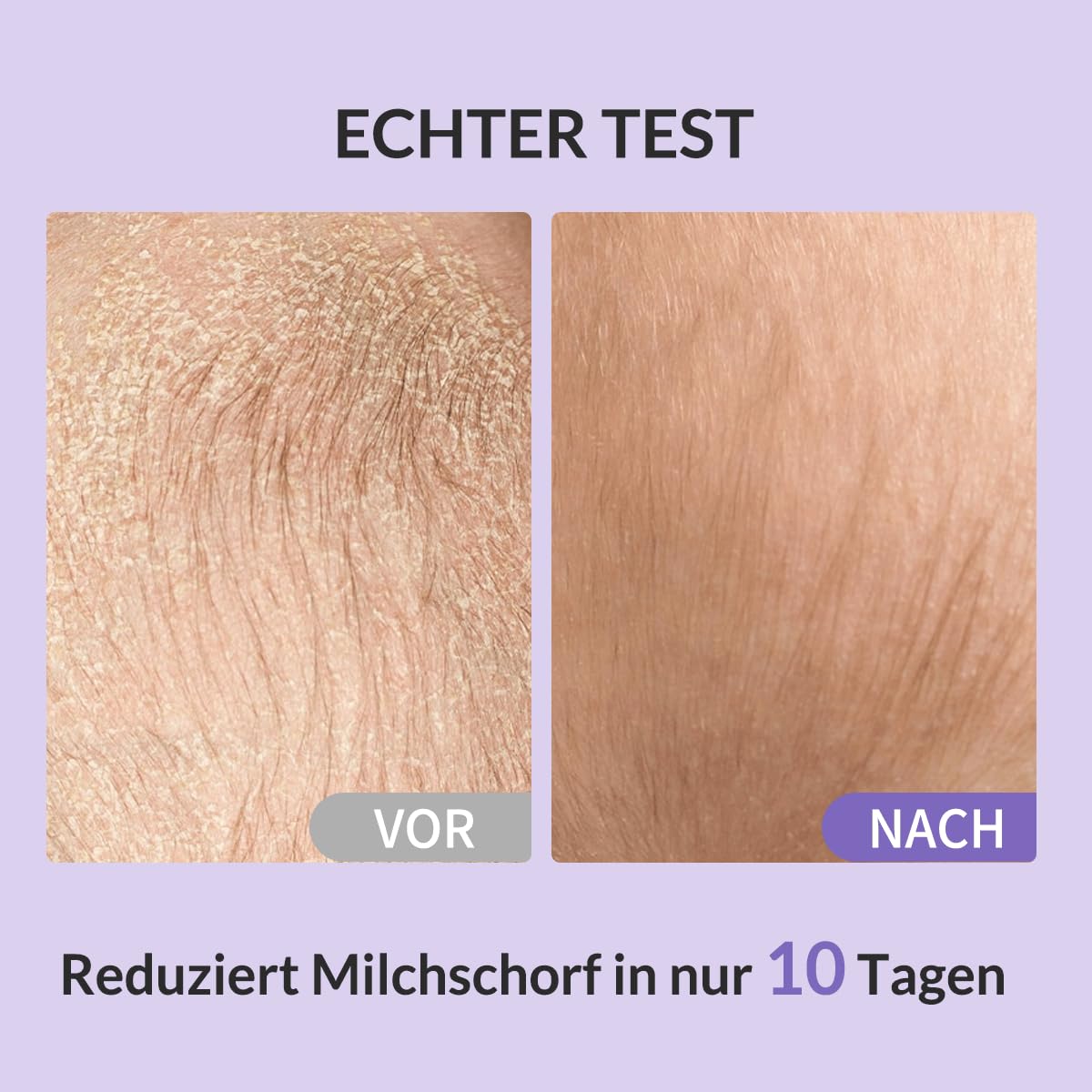 Bee Nature - Baby Shampoo Bio - Milchschorf Behandlung - Tränenfrei - 99.3% Natürlich - Honig Mousse - Geeignet für Neugeborene, Kinder, Erwachsene mit Trockener, Empfindlicher, Ekzem Kopfhaut - 200ml 4