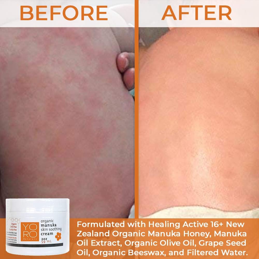 YoRo Naturals, Organic Manuka Skin Soothing Creamy Balm, Relief from Eczema, Psoriasis, Diaper Rash, Sunburns, Cuts & Scrapes (2 OZ): Health & Personal Care