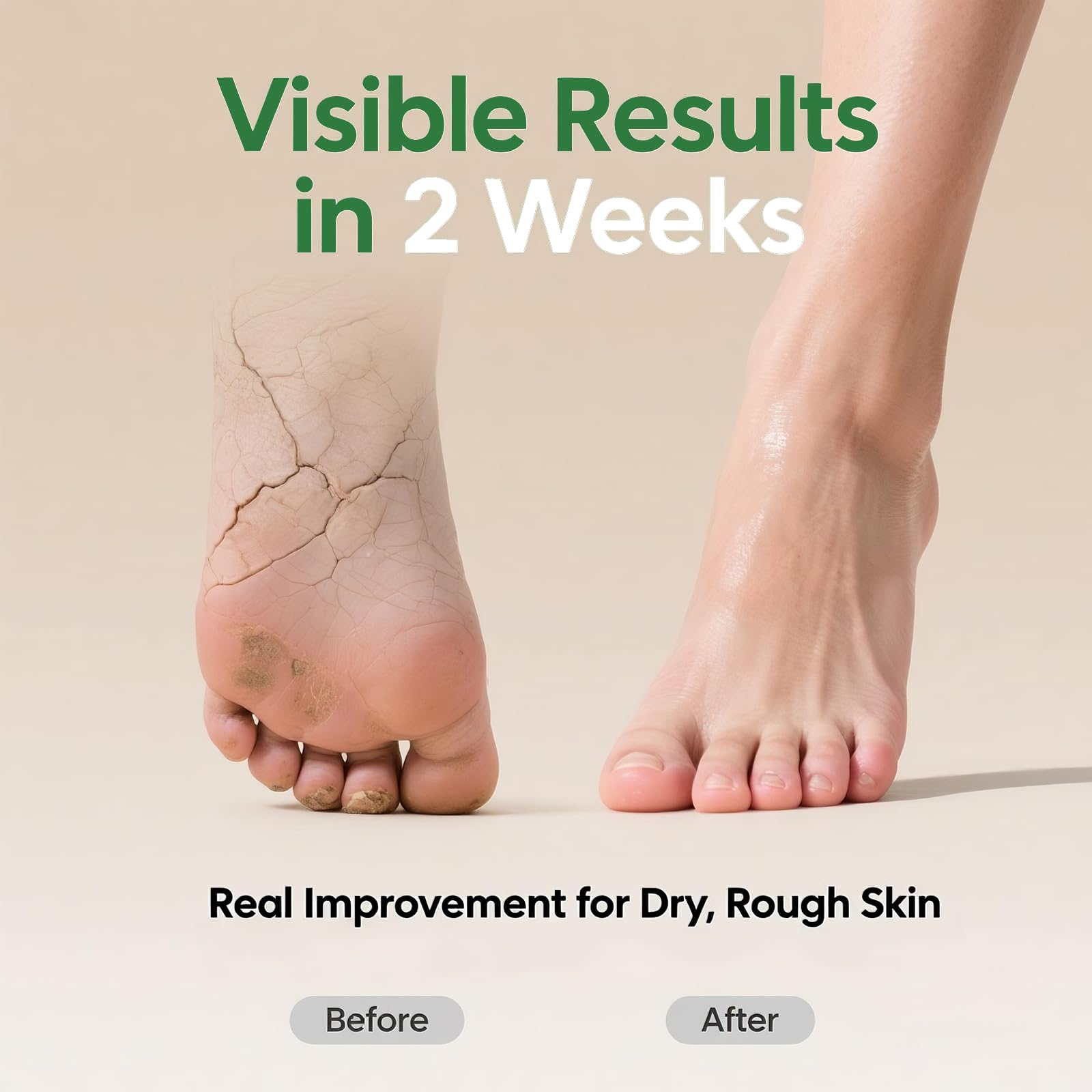 60% Urea Cream with 2% Salicylic Acid, Urea Cream 60 Percent for Feet & Hands, Maximum Strength Moisturizer Foot Lotion for Dry Cracked Heels Feet Knees Elbows Hands, Callus Remover, 10.1 fl oz