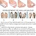 Skyfoot’s Bunion Relief, Toe Corrector and Separator Bunion Pad Kit for Correct Hallux Valgus - 8 Pieces