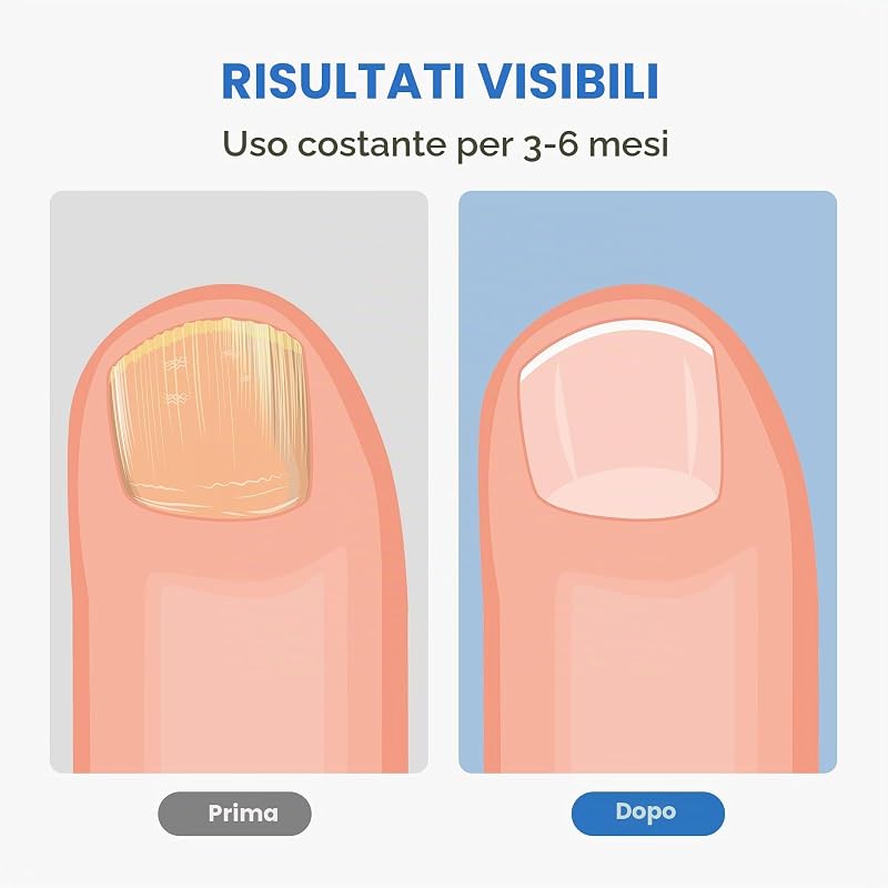 Dispositivo Laser dei Funghi Unghie Indolore, Berrlly Dispositivo Laser di Trattamento per Funghi Unghie, Portatile con Typo C Cavo, 7 Minuti al Giorno Ripristinare Bellezza Adatto per Casa (Negro) — foto 3 di 8