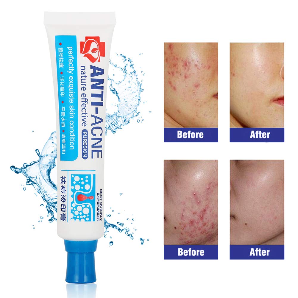 anti pimple face cream