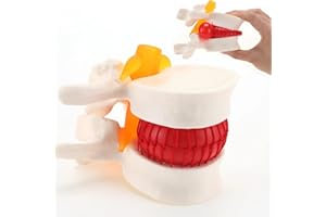 LYOU Human Anatomical Lumbar Disc Herniation Model - Lumbar Spine Model for Teaching & Learning, Life Size Lumbar Disc Herniation Model - Excellent Way for Demonstrating Disc