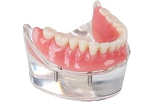 SOARDAY Dental Restoration Model with 4 implants Overdenture Inferior Teaching Study Teeth Model