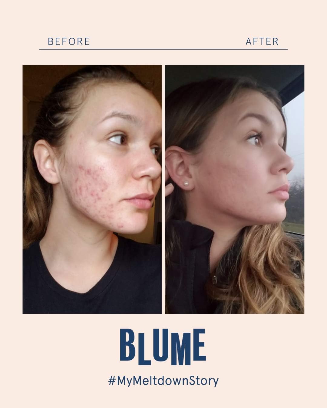blume meltdown cystic acne