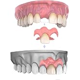 Partial Dentures for Women &amp; Men (One Tooth) | Custom Replacement Temporary Flipper Teeth for No Teeth &amp; Missing Tooth | 1&ndash;6 Tooth Set with Mold
