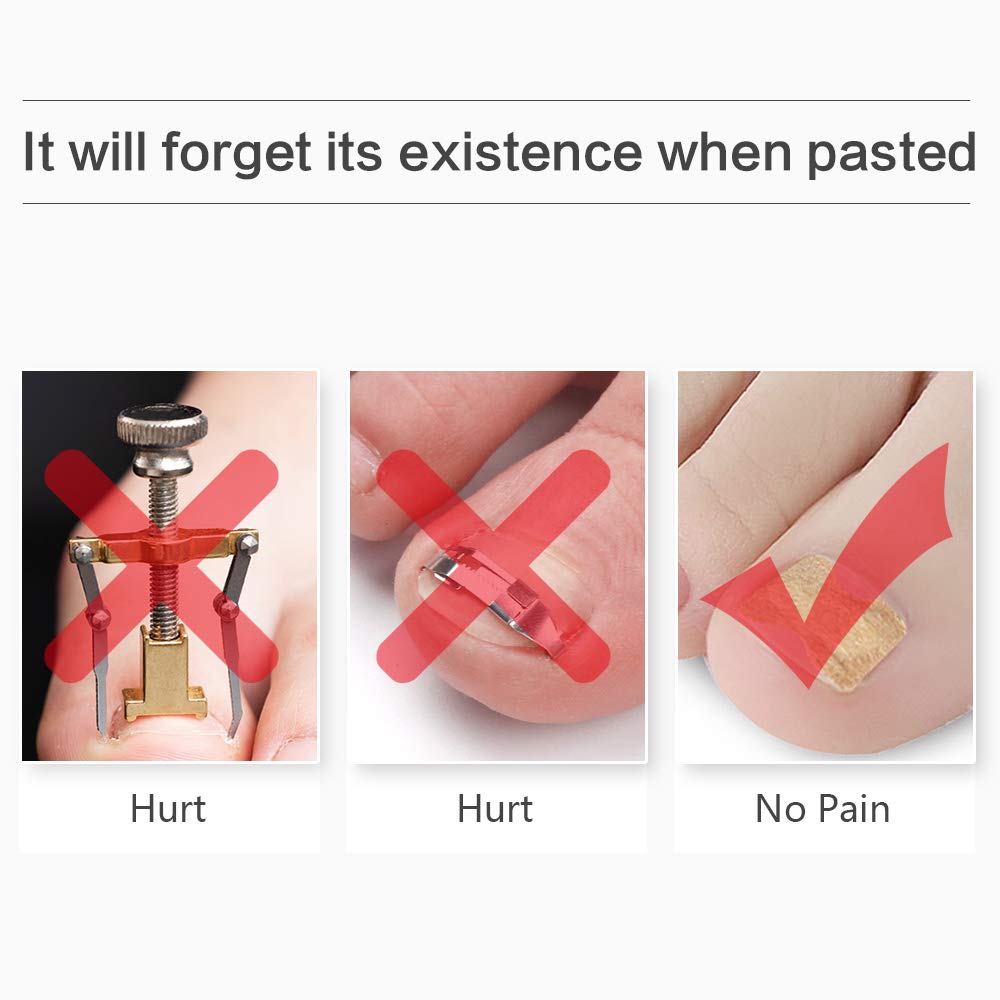 10 Sheet 100 pcs Ingrown Toenail Stickers Glue-free Toe Nail Correction Tools Professional Pedicure Tools, Foot Care Stickers for Unisex: Beauty