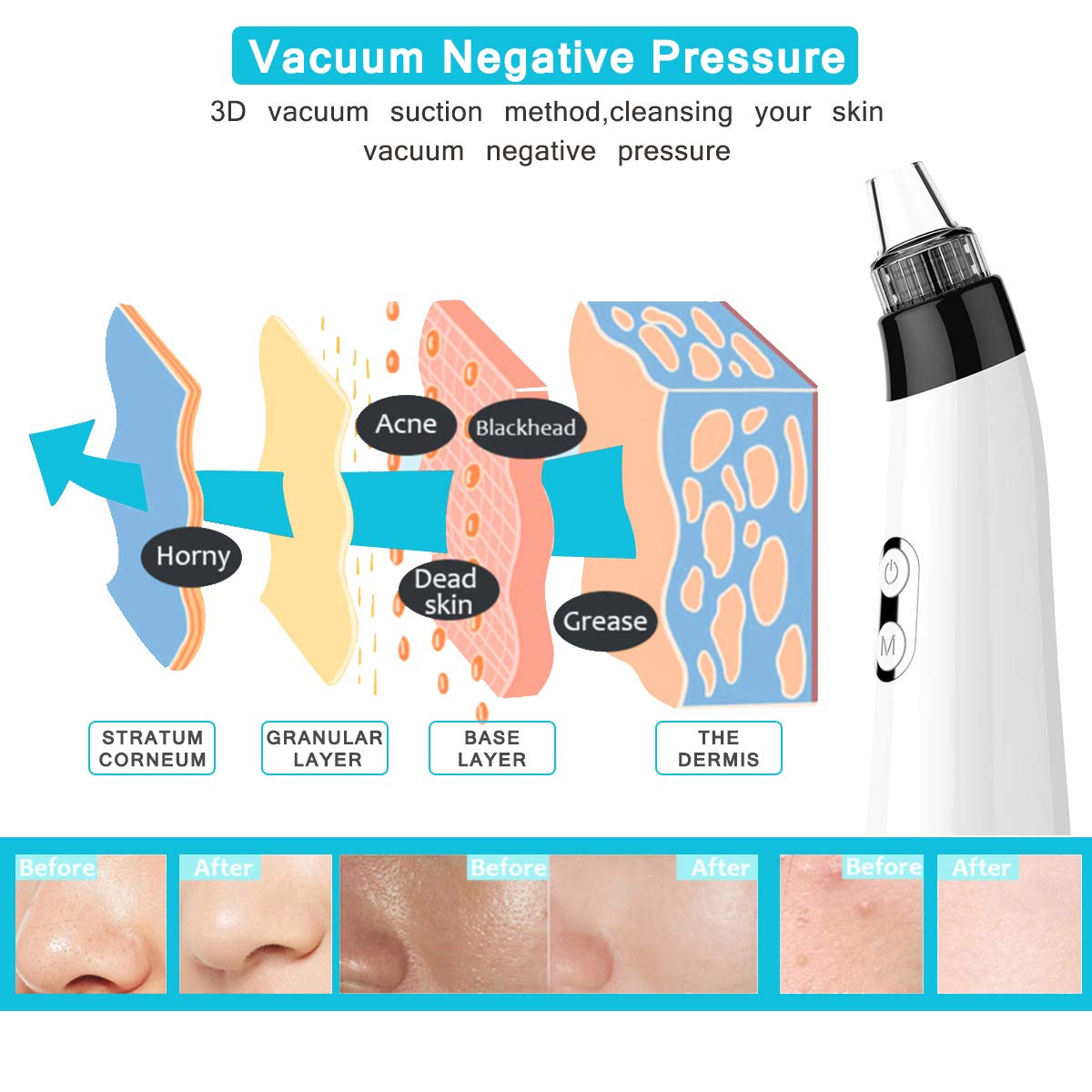 Blackhead Remover Pore Vacuum, Rechargeable Electric Facial Acne Cleaner Tool & 5 Probes Microcrystalline & Facial Massage Rolling Head for Eye Nose Face Skin Acne Comedone Extractor