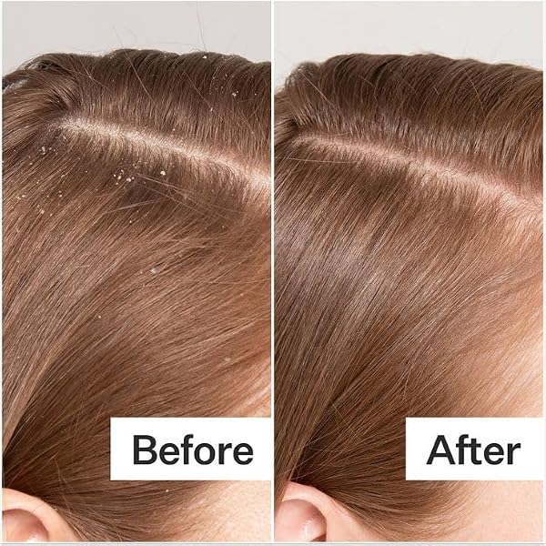 SCALP SERUM FOR THINNING HAIR, 30ML – CLINICALLY TESTED, NOURISHING FORMULA WITH AMINO ACIDS, CAFFEINE & ROSEMARY OIL – PROMOTES HEALTHY SCALP & FULLER-LOOKING HAIR, REDUCES OIL & PRODUCT BUILDUP