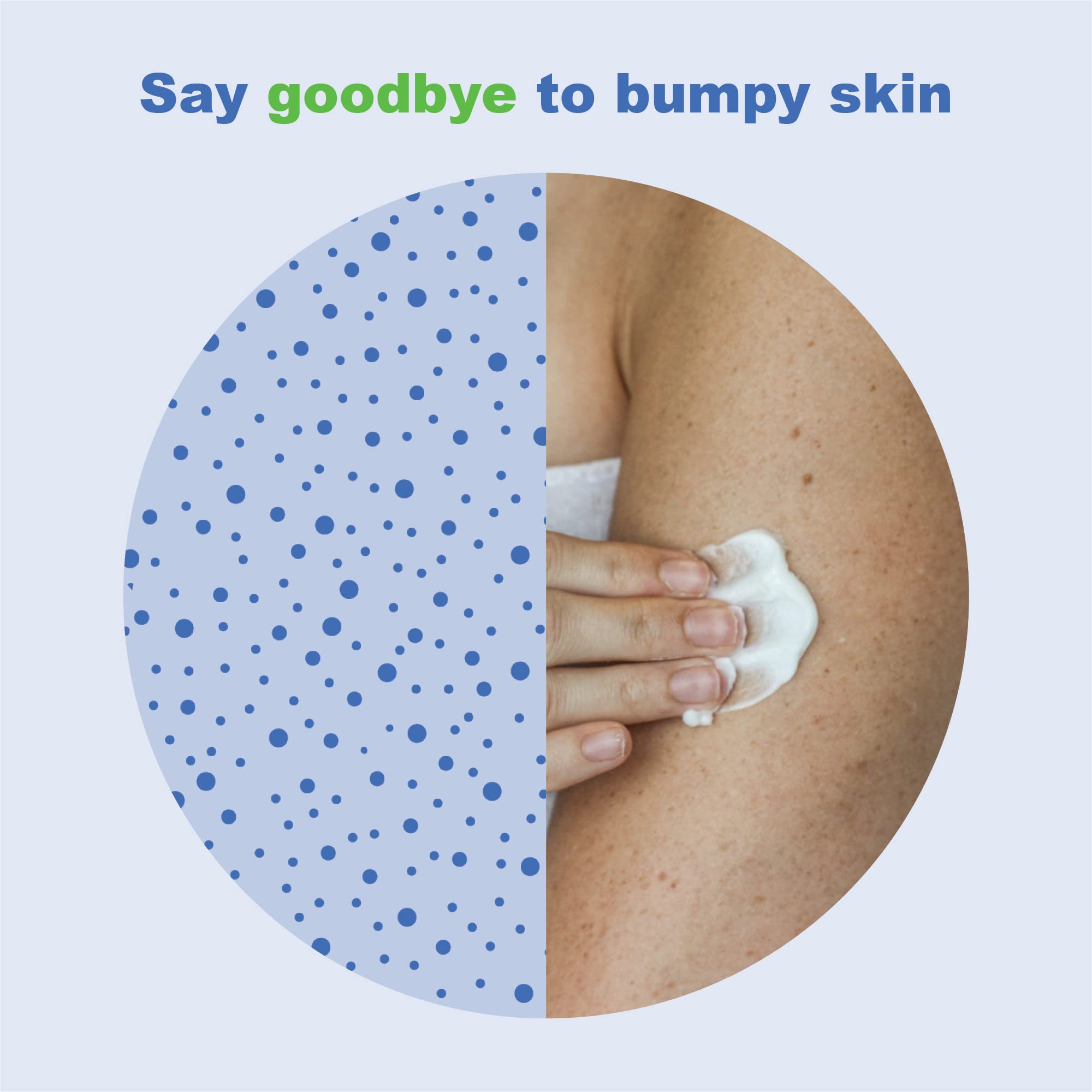 KP Elements Keratosis Pilaris Lotion (4 Fl Oz) Natural Keratosis