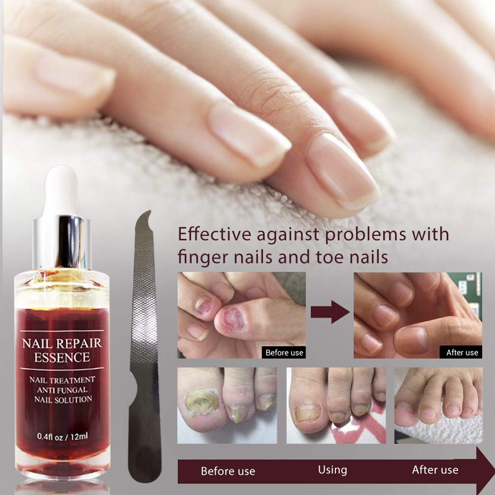 Fanmin Toenail and Nail Repair Essence, Remove Paronychia Onychomycosis Toe, Toenail and Nail Care Solution, Toenail and Nail Renewal, Fixes and Restores Discolored and Damaged Nails : Beauty