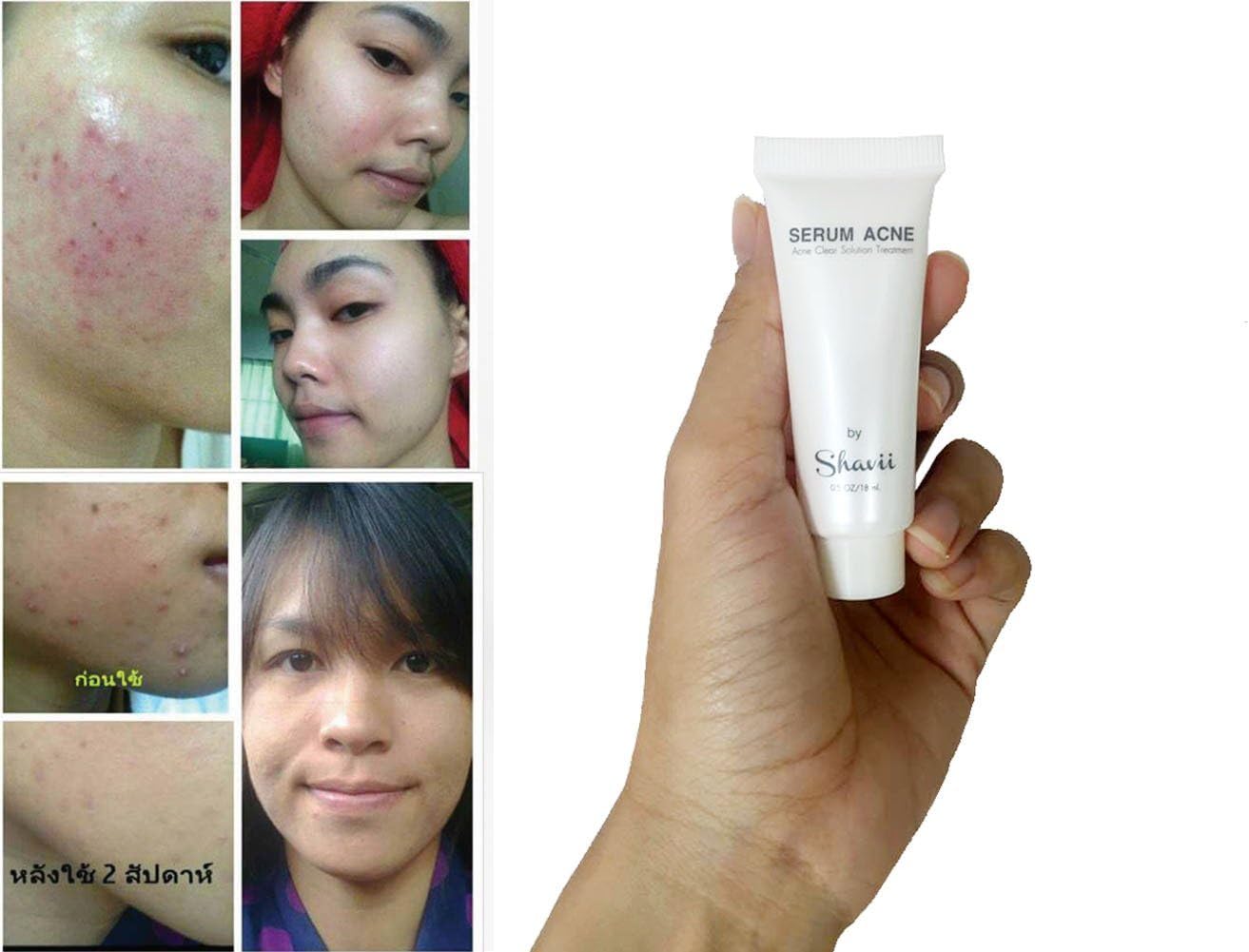 Acne Treatment Serum Acne Clear and Repairing 18 ml. See Clearly See Results Within 7-14 Days Acne Skin Care