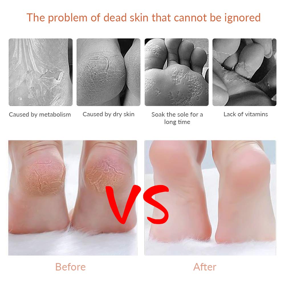 Codream Pedicure Callus Shaver Foot File Care Hard Skin Remover Callus Shaver Sets with Case, Foot File Heads & 10 Replacement Blade for Hand Feet : Beauty
