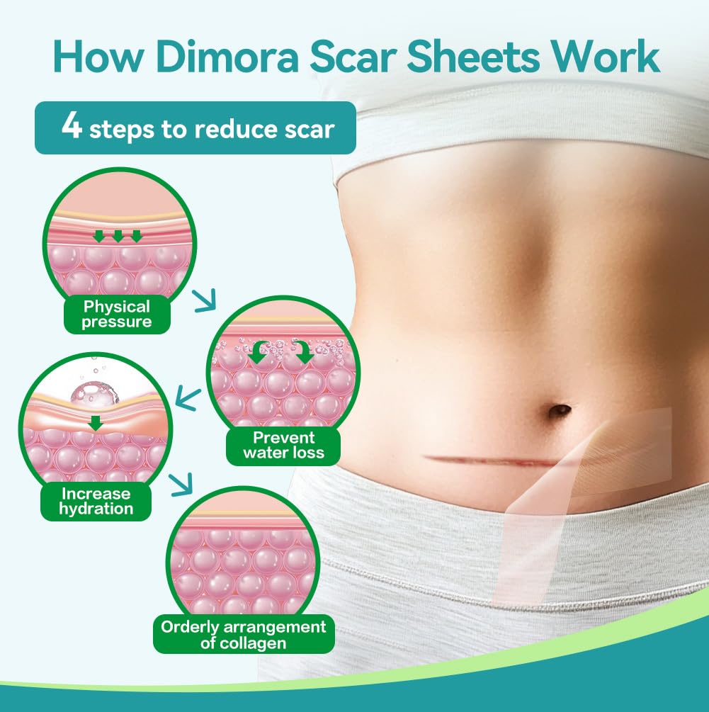 Dimora Medical Grade Silicone Scar Sheets -Ultra Soft Silicone Scar Tape (1.6”x60