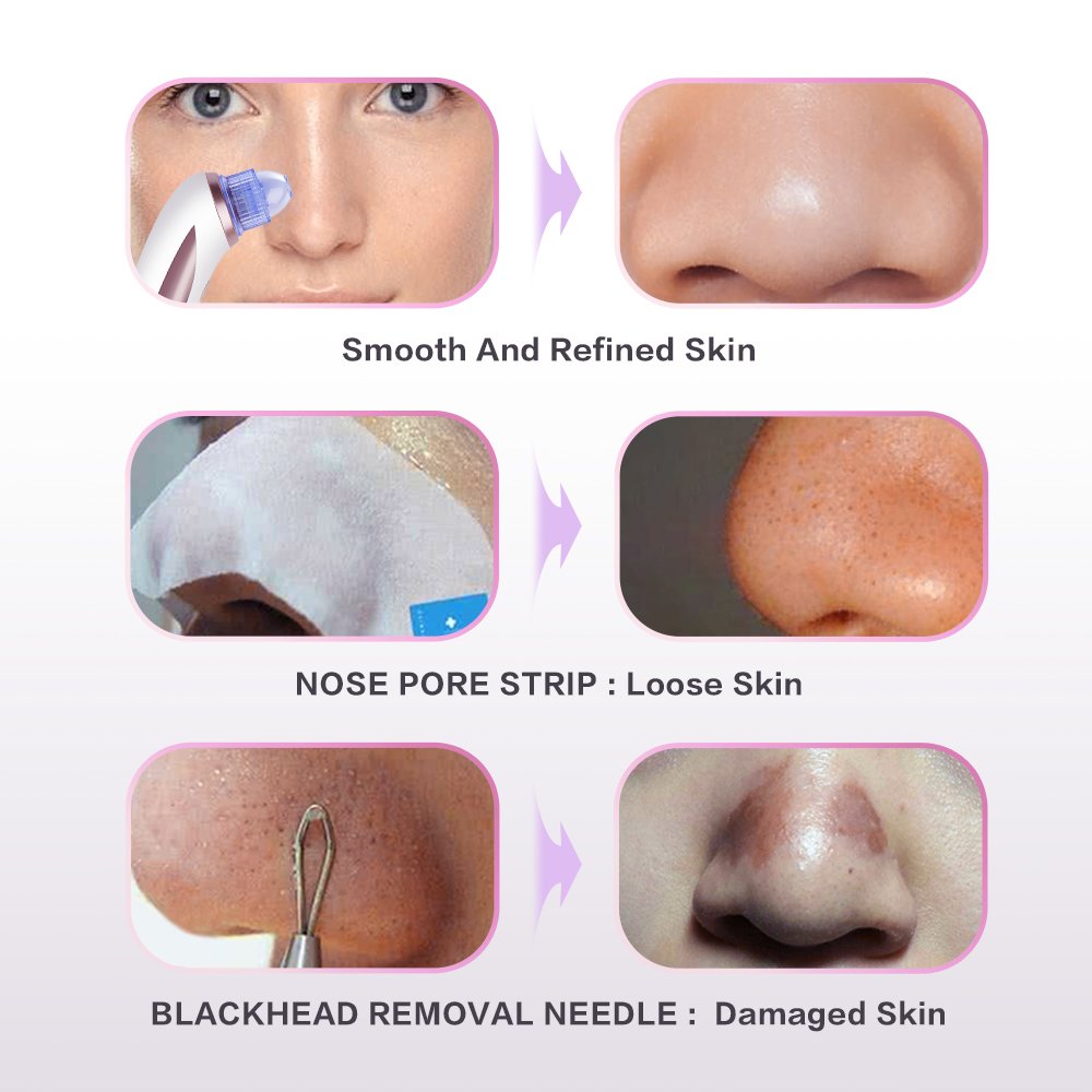 Blackhead Remover, MeanLove Electric Facial Pore Cleanser Blackhead Acne Suction Remover Vacuum Extraction Tool, 4 Intensity Levels with Led Indicator  (White+Silver)