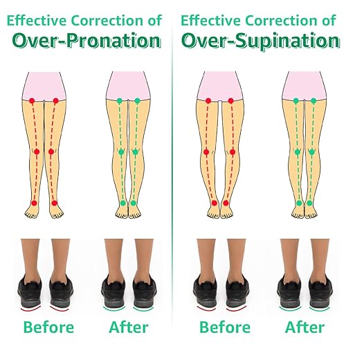 Pronated Foot Knee Pronation Flat Foot And Knee Pain Pronation