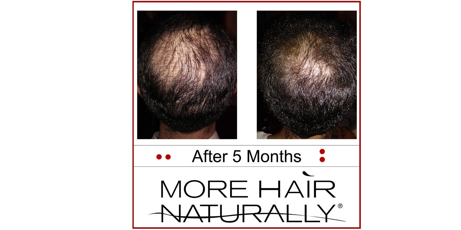 More Hair Naturally 9 Advanced Stem Cell Therapy For Thinning Hair Beauty Amazon Com