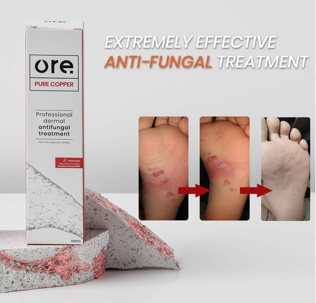 Ore® Copper Professional Dermal Anti-fungal Treatment Spray, 100% Natural for Athletes Foot Ringworm, Jock Itch - Image 4