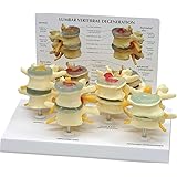 4-stage Osteoporosis Vertebrae Anatomical Model