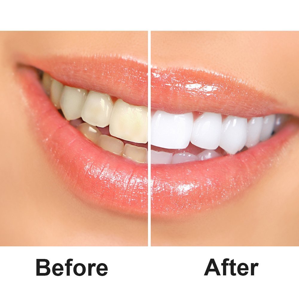 Grinigh COCONUT OIL Whitestrips Dental Professional Effects Teeth Whitening Strips Kit, 14 Treatments - Lasts 6 Months & Beyond - Non-Slip White Strips with a Fresh COCONUT Fragrance