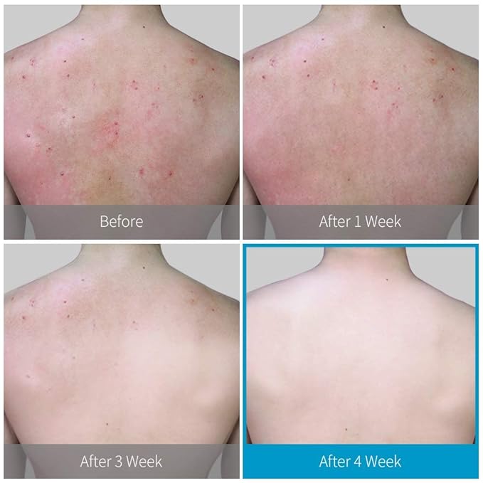 bio peel back acne