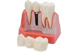Healthible Dental Implant Model - Implant Vs Bridge Dental Model 4 Times Removable Analysis Crown Bridge Demonstration Teeth Model