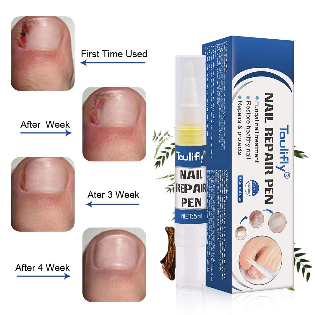 Nail Repair, Nail Repair Pen, Nail Solution, Natural Nail Treatment, Effective Against Nail Infection Restores Discolored & Damaged Nails 4pc : Beauty