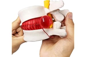 EVOTECH SCIENTIFIC Human Herniated Disc Model, Anatomical Herniated Lumbar Vertebrae Disc Prolapse Model for Medical Teaching & Education Kids Learning Education Display Tool