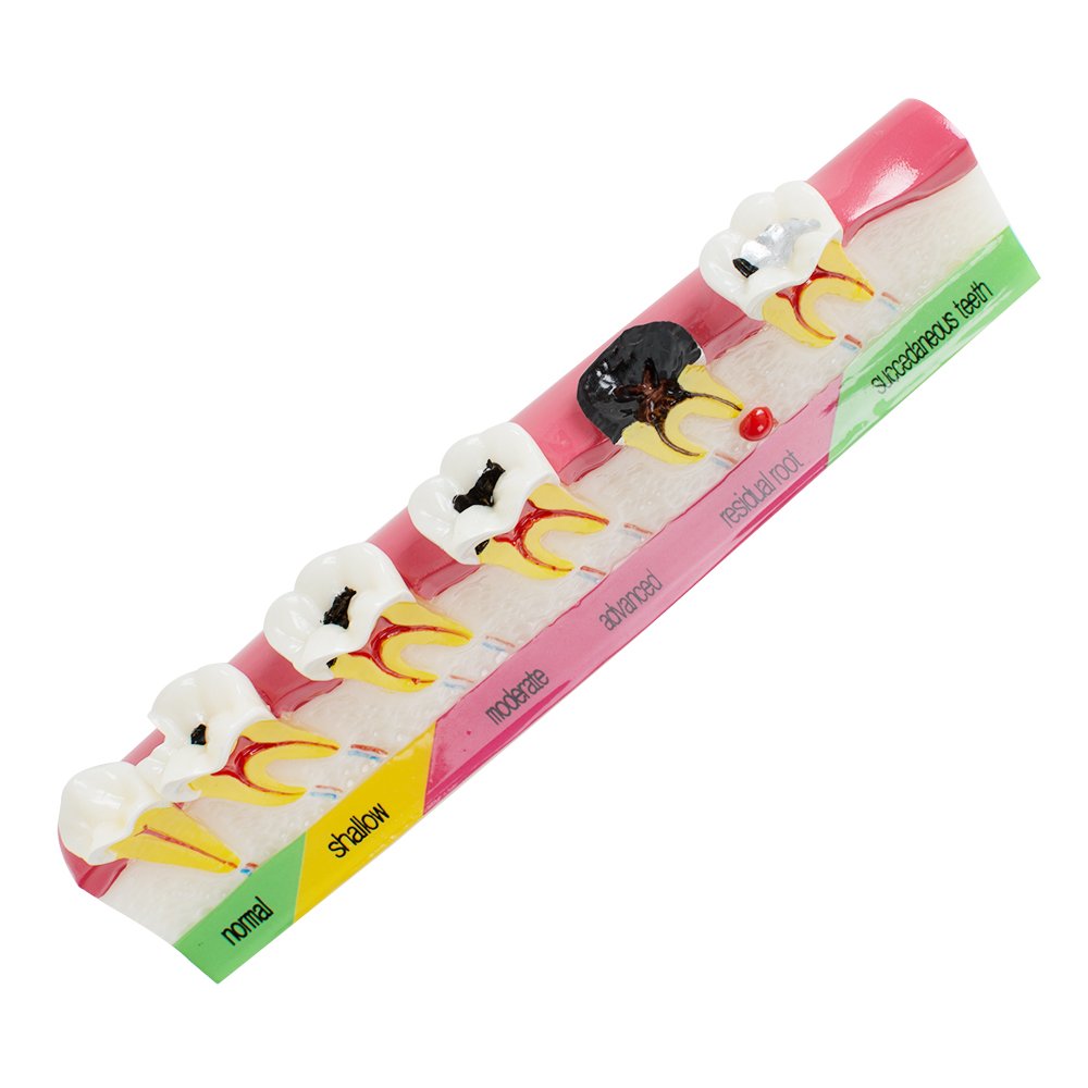 Pevor Dental Teeth Model Periodontal Disease Assort Tooth Typodont Study Teaching Model